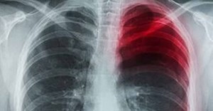 боль в легких 2