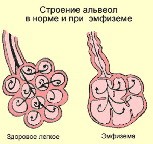 Альвеолы эмфиземы легких